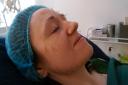 Paula undergoes her cosmetic acupuncture treatment at Acusports in Glasgow